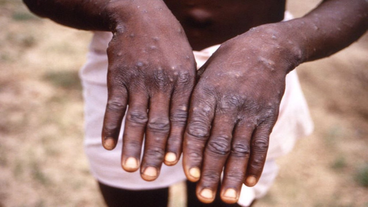 Sebuah gambar yang dibuat selama penyelidikan wabah cacar monyet di Republik Demokratik Kongo (DRC) dari 1996 hingga 1997, menunjukkan tangan seorang pasien dengan ruam akibat cacar monyet. (Handout CDC via Reuters)