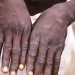 Ilustrasi - Pengidap virus cacar monyet (monkeypox). (ANTARA/Sutterstock/aa)-1698317237