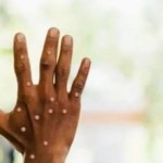 Monkeypox-1697524072