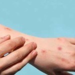 Ilustrasi - Cacar Monyet atau Monkeypox. ANTARA/freepick/pri-1699425235