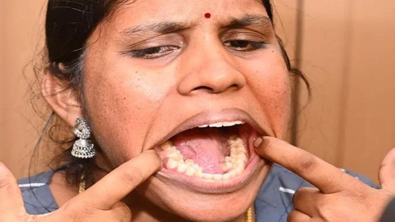 Kalpana Balan dianugerahi gelar rekor dunia guinness untuk gigi terbanyak di mulutnya. (Guinness World Records)
